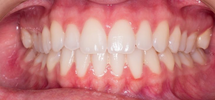 Principales síntomas de la gingivitis y la periodontitis