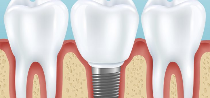 ¿Qué es la implantología dental?