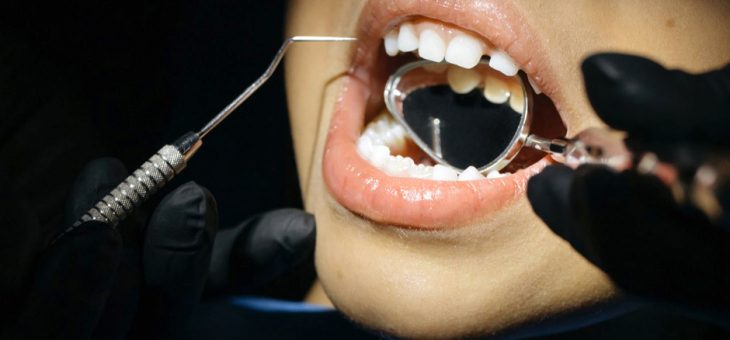 ¿Cómo prevenir caries con selladores dentales?