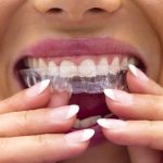 ortodoncia invisible