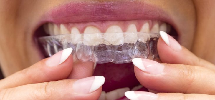 Ortodoncia invisible: 4 casos en los que no funciona