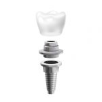 implantes dentales Gadir Dental