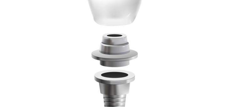 Implantes dentales: ¿qué puede fallar?