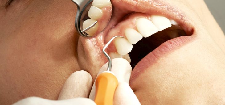 Higiene dental profesional. ¿Cuál es la frecuencia ideal?