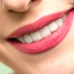 blanqueamiento dental en Tenerife